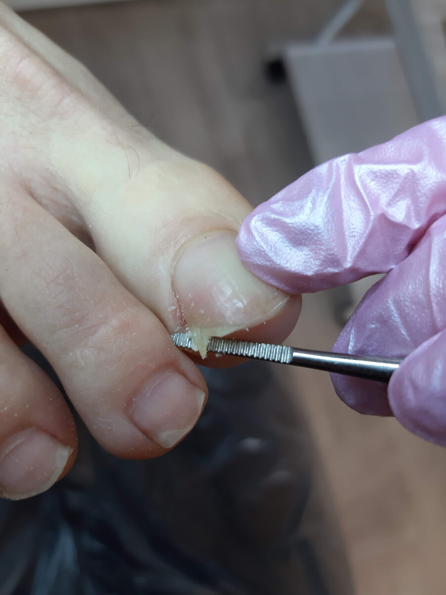 Миллионы людей страдают от проблемы вросшего ногтя, но не все знают, почему это происходит и как себе помочь.