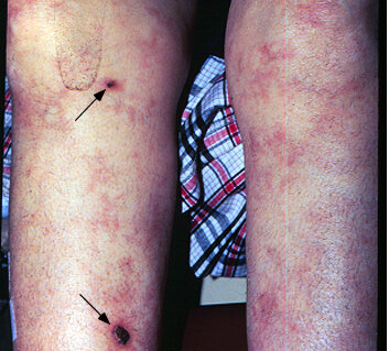 Сетчатое ливедо, стрелками указаны язвы на фоне болезни