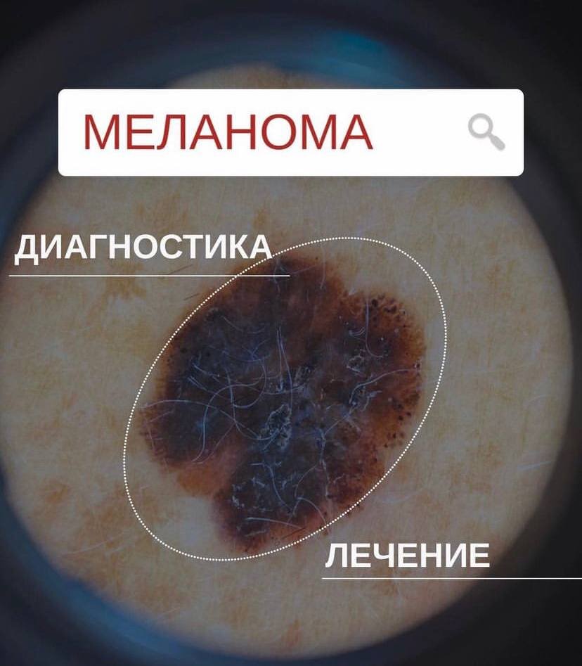 Меланома через дерматоскоп