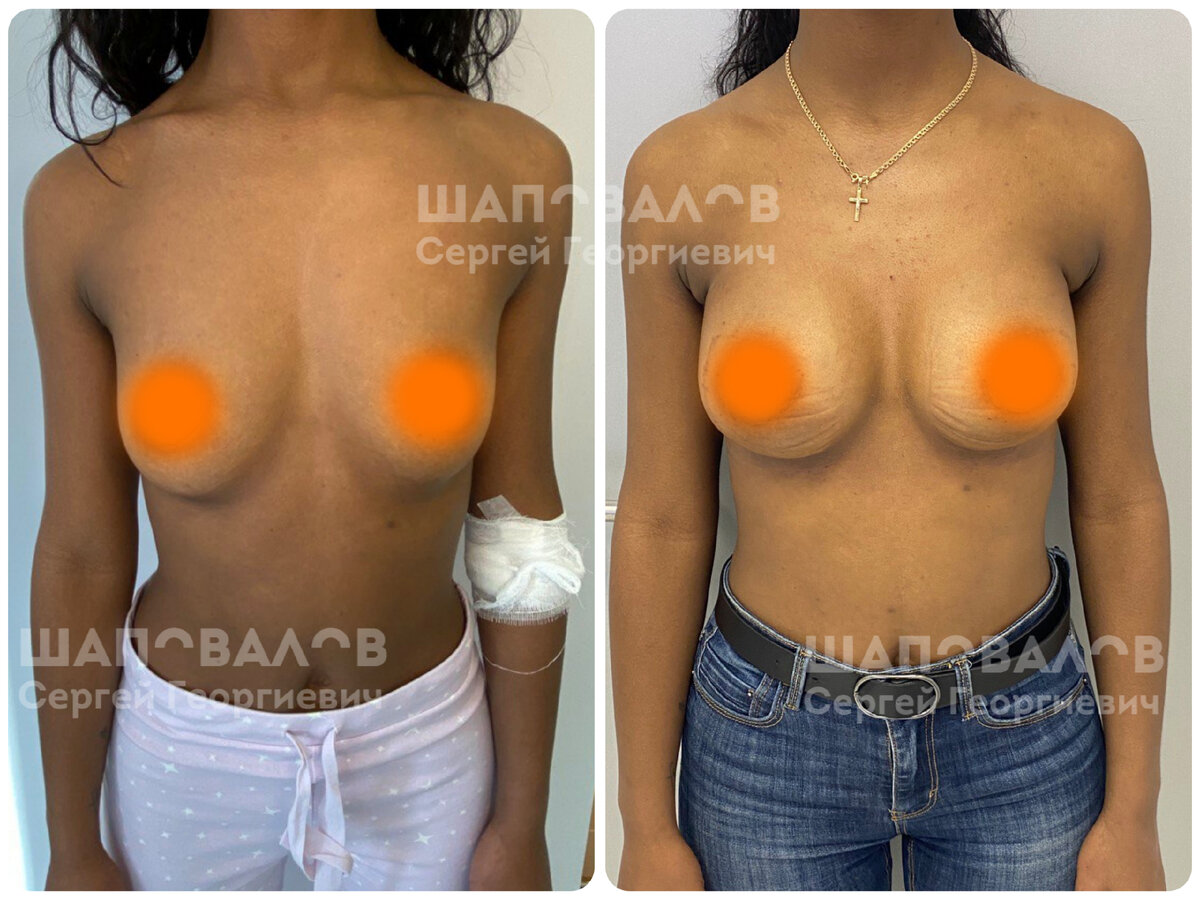 операция на груди у женщин фото 102
