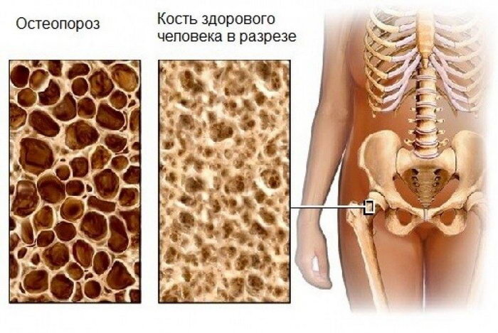 Пример кости с остеопорозом и здоровой кости.