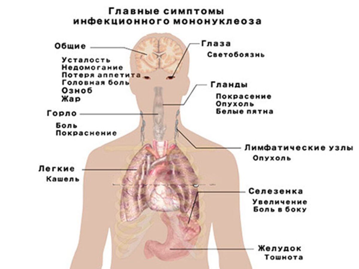 Перенесли мононуклеоз