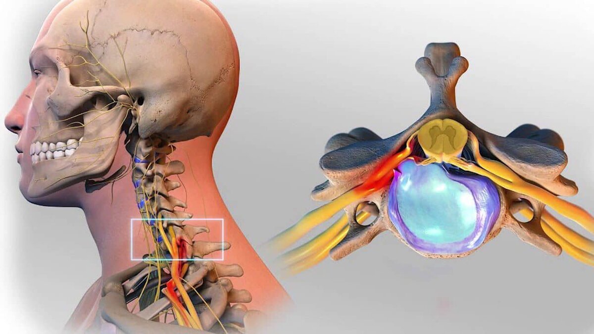 Грыжа шейного отдела можно ли массаж