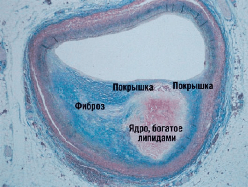 Так выглядит срез артерии с атеросклеротической бьяшкой. Изображение с сайта: https://duyc.ru/kriterii-diagnostiki-infarkta-miokarda-kriterii-ostrogo-infarkta.html