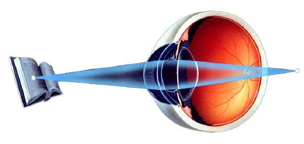  Это 3-я часть статьи «Близорукость и дальнозоркость простыми словами». Специалисты выделяют три степени дальнозоркости: 1. слабой степени – до 2.0Д 2. средней степени – от 2.25 до 5.0Д 3.-2