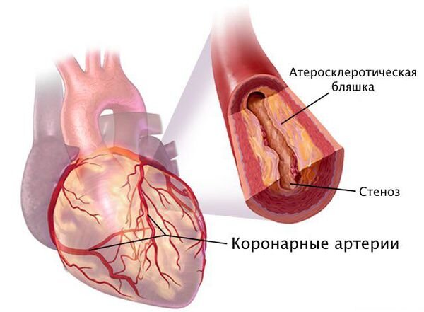 Боль в области сердца