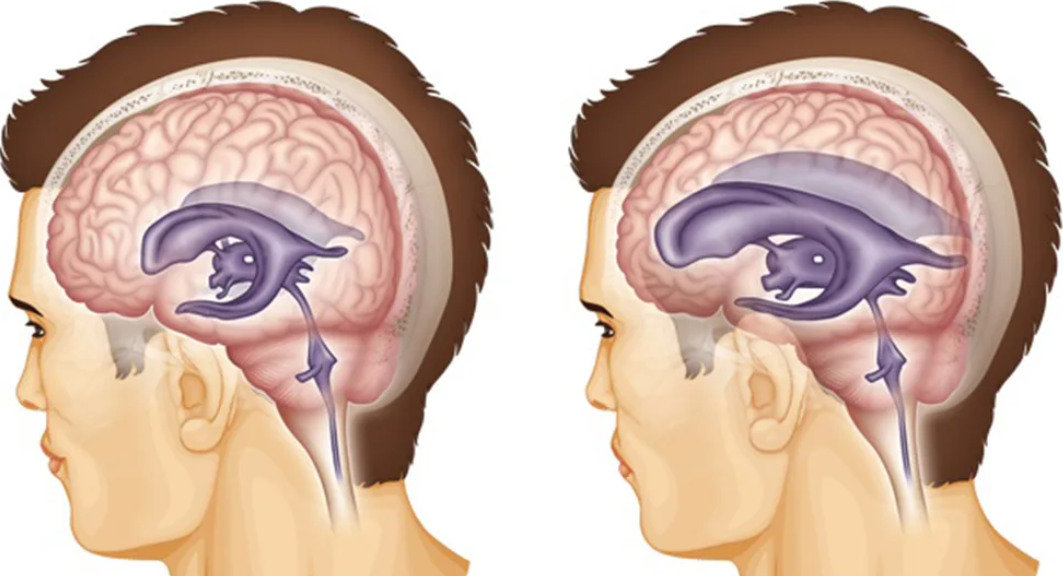 Гидроцефалия у детей и взрослых: признаки, причины, лечение