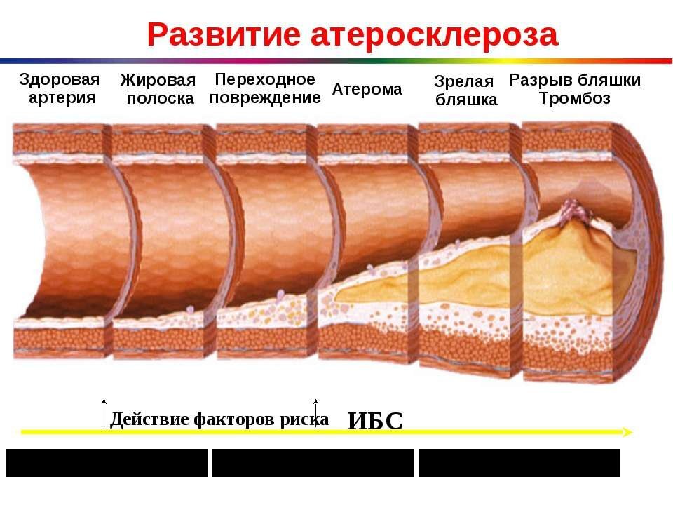 Стадии атеросклероза картинки