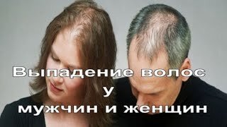 Что Делать Выпадают Волосы? Андрогенное Облысение!