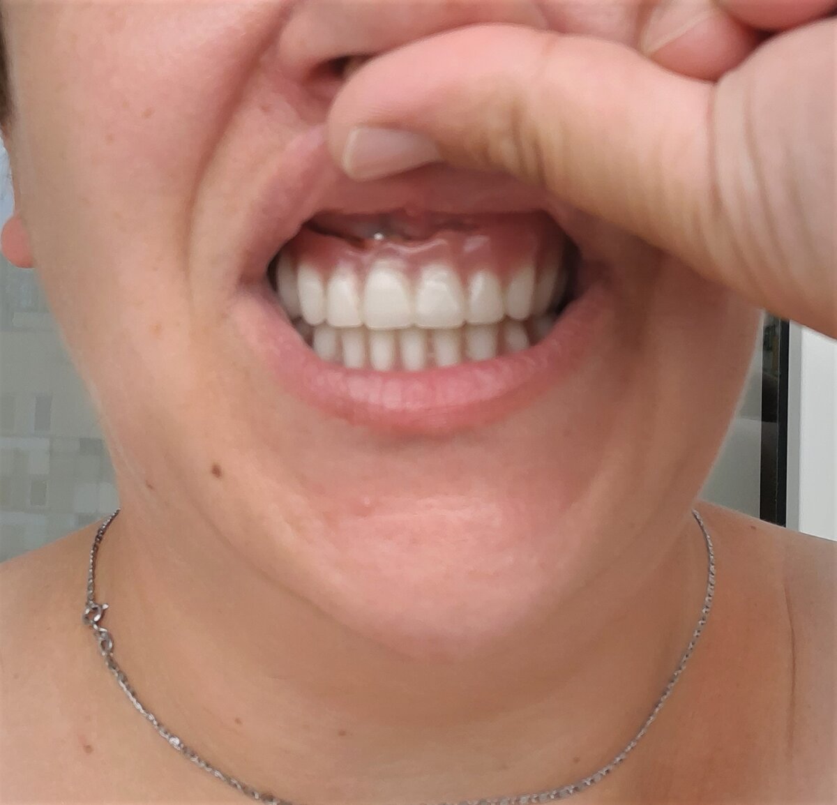 Было. Это старое фото! Обратите внимание на толщину и высоту пластика искусственной десны и торчащий металлический мультиюнит