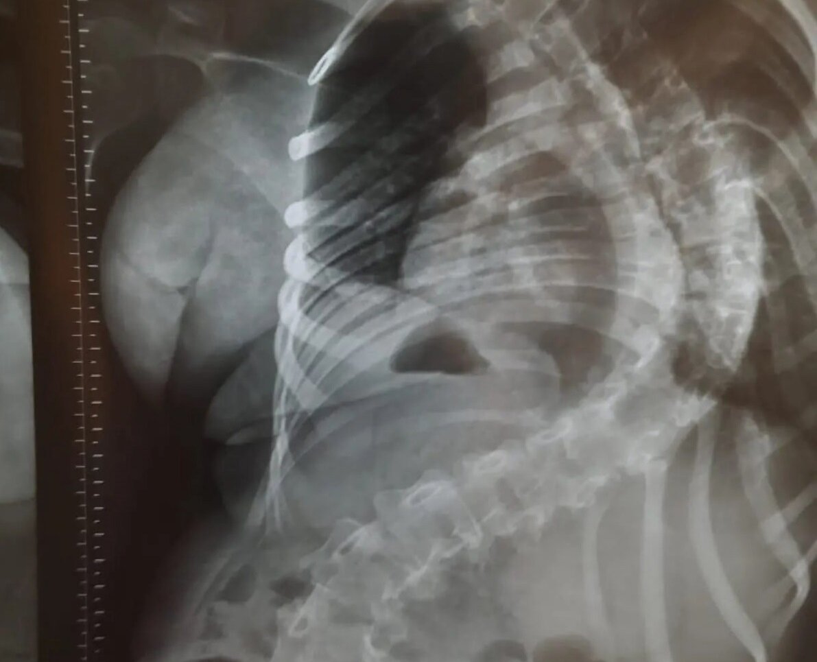 Света Королёва-Фаль, подопечная нашего фонда