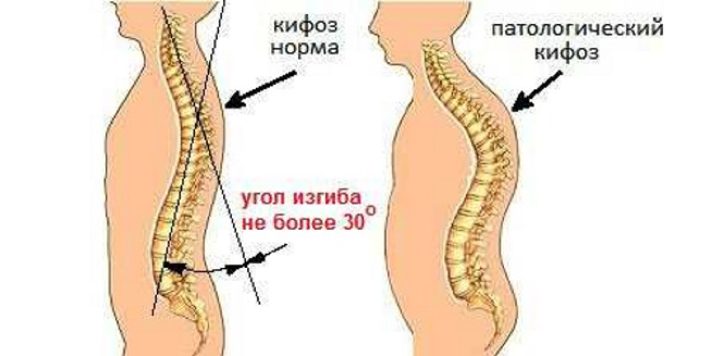 Грудной кифоз. Патологический кифоз с4. Угол кифоза грудного отдела позвоночника. Норма кифоза грудного отдела позвоночника. Кифоз верхнего грудного отдела позвоночника