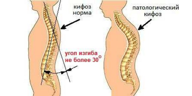 2 кифоза. Патологический кифоз с4. Угол кифоза грудного отдела позвоночника. Норма кифоза грудного отдела позвоночника. Кифоз верхнего грудного отдела позвоночника.