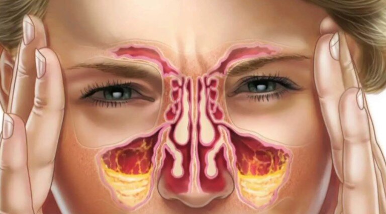 Причины, вызывающие насморк (ринит)