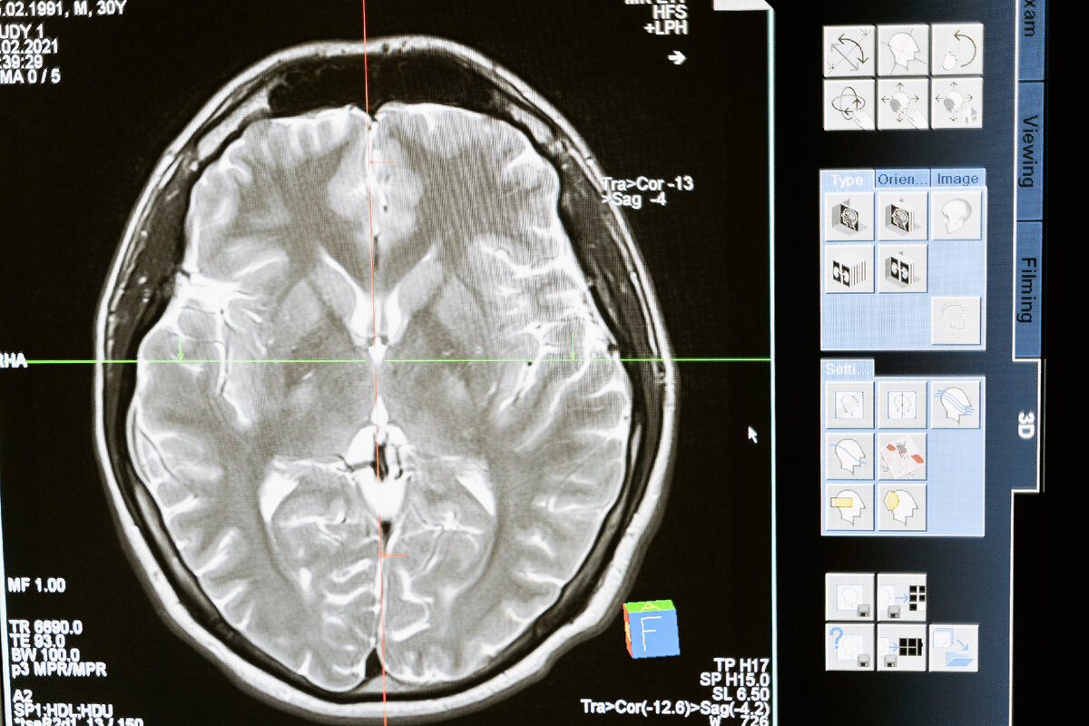 Эпилептический синдром возникает из-за сбоя в работе нейронов