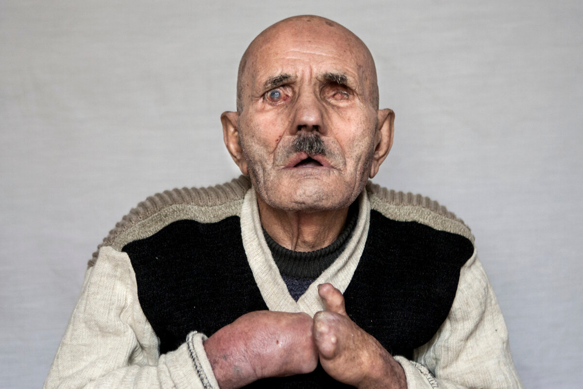 Мужчина, переболевший проказой.