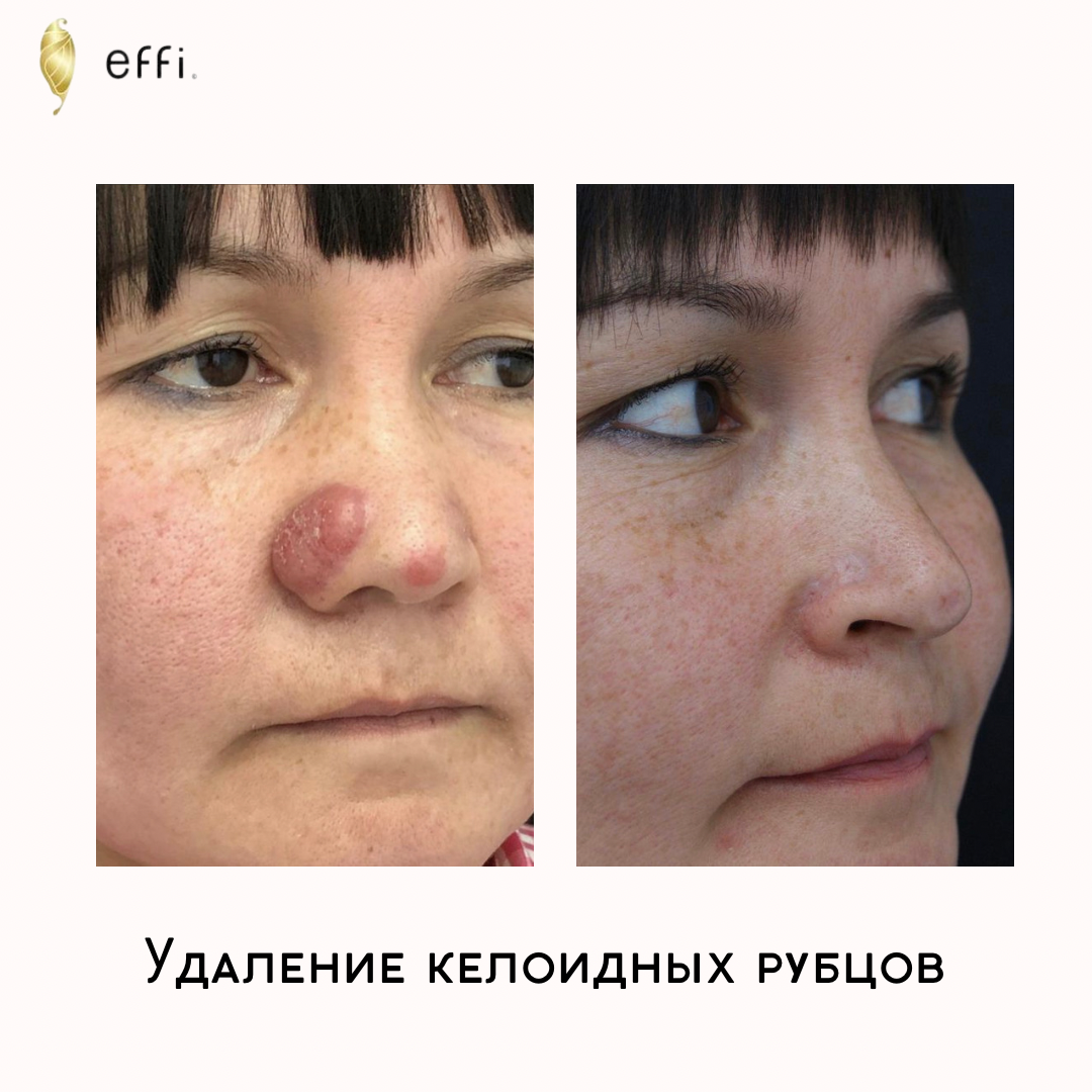 Келоидный рубец фото до и после лечения