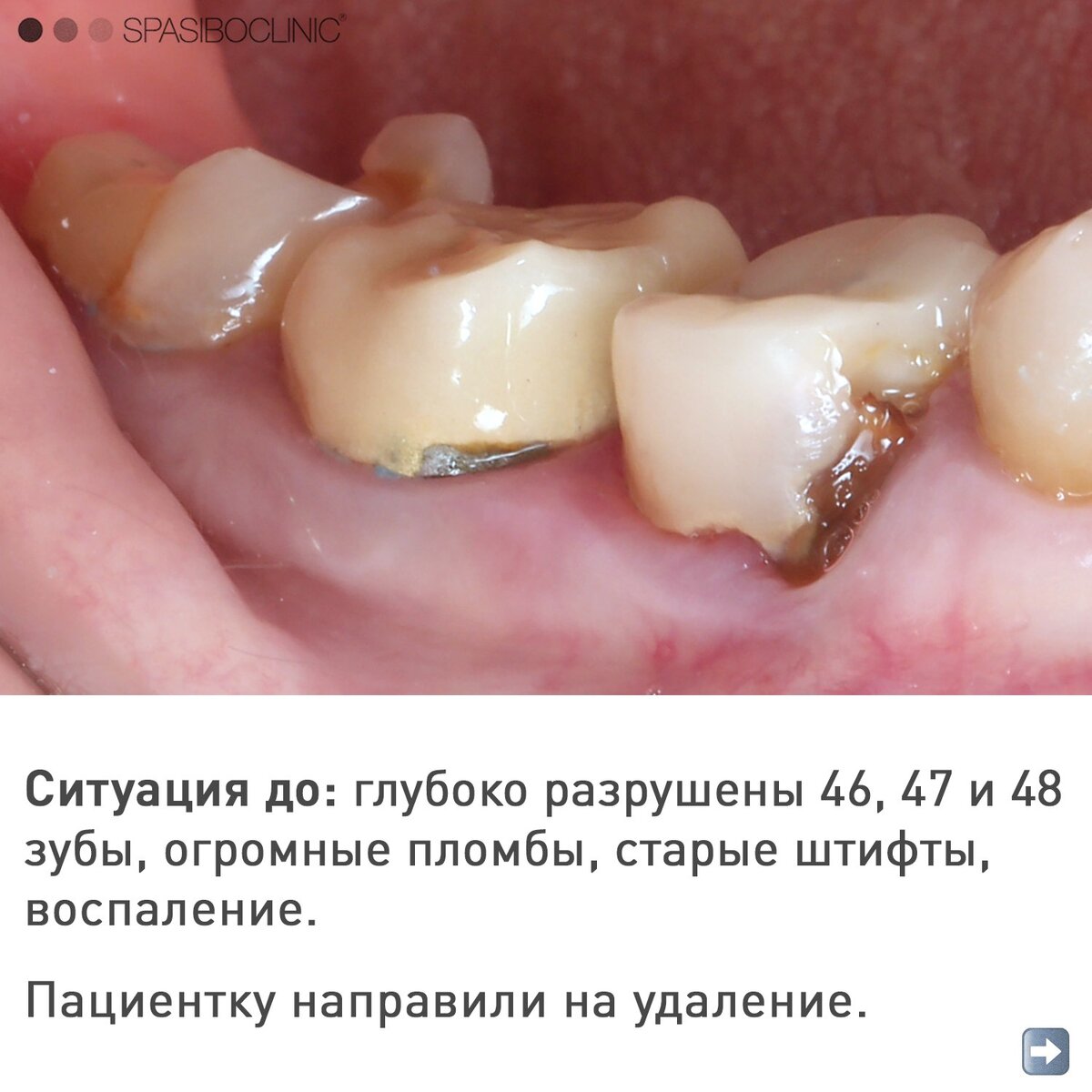 Кариес зуба мудрости: лечить или удалять