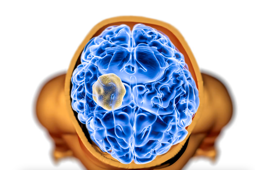     Рак головного мозга научились диагностировать по капле крови на ранней стадии