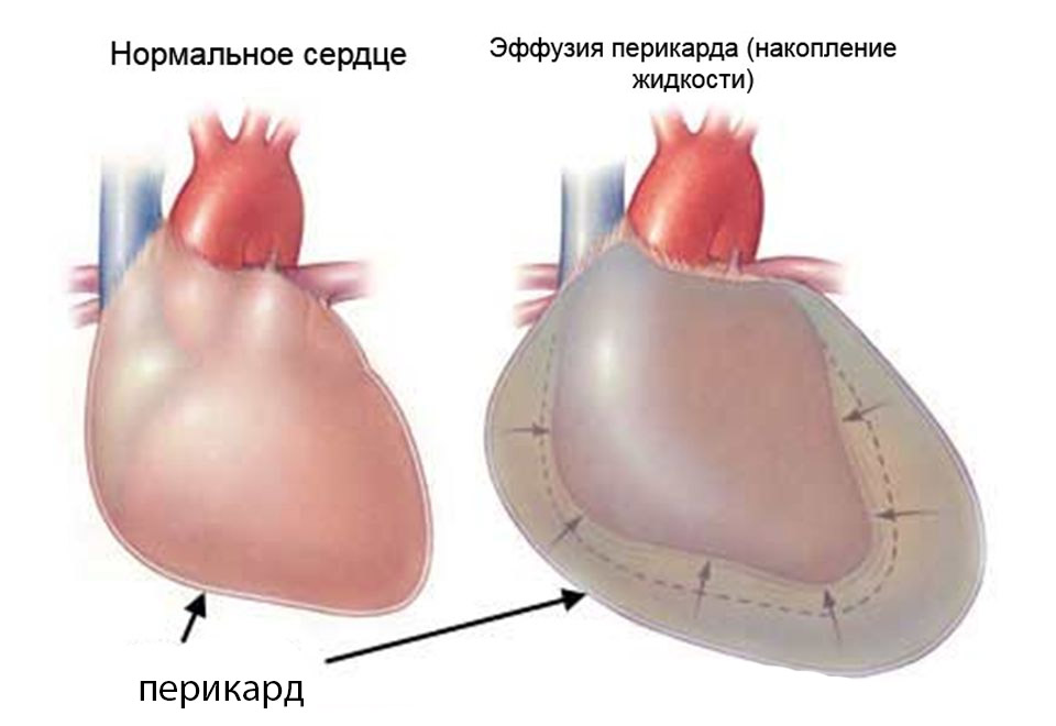 Перикардит: виды, симптомы, диагностика, лечение, профилактика