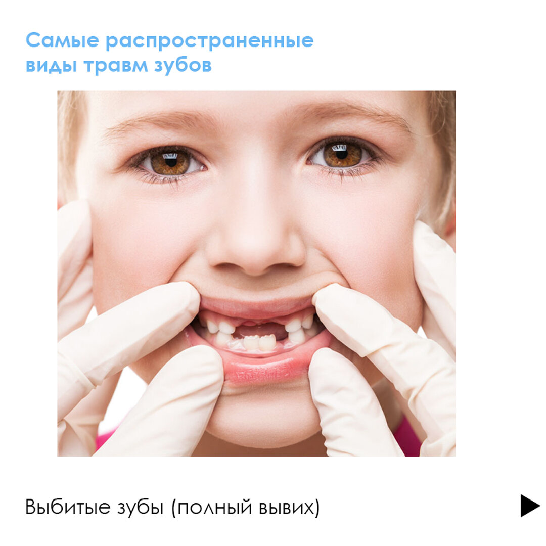 Травма зуба у ребенка? 🦷 Скорее к стоматологу!⠀ | Клиника Здоровья Исток |  Дзен