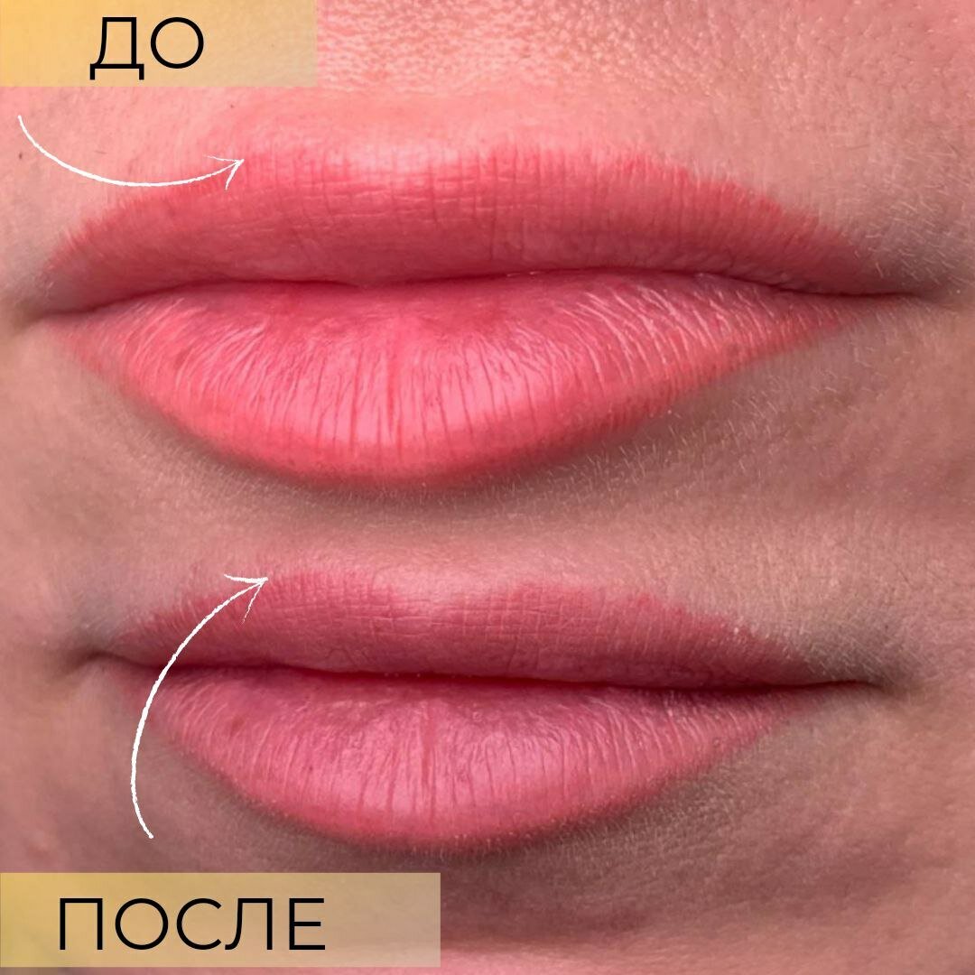 Сверху - до обработки контура ремувером. Снизу - через месяц после процедуры