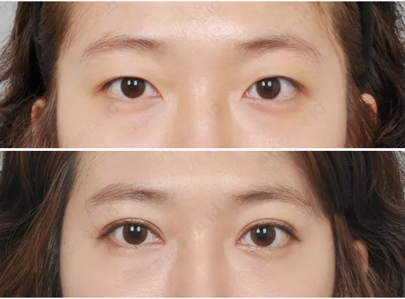 Pin on Eyelid Surgery