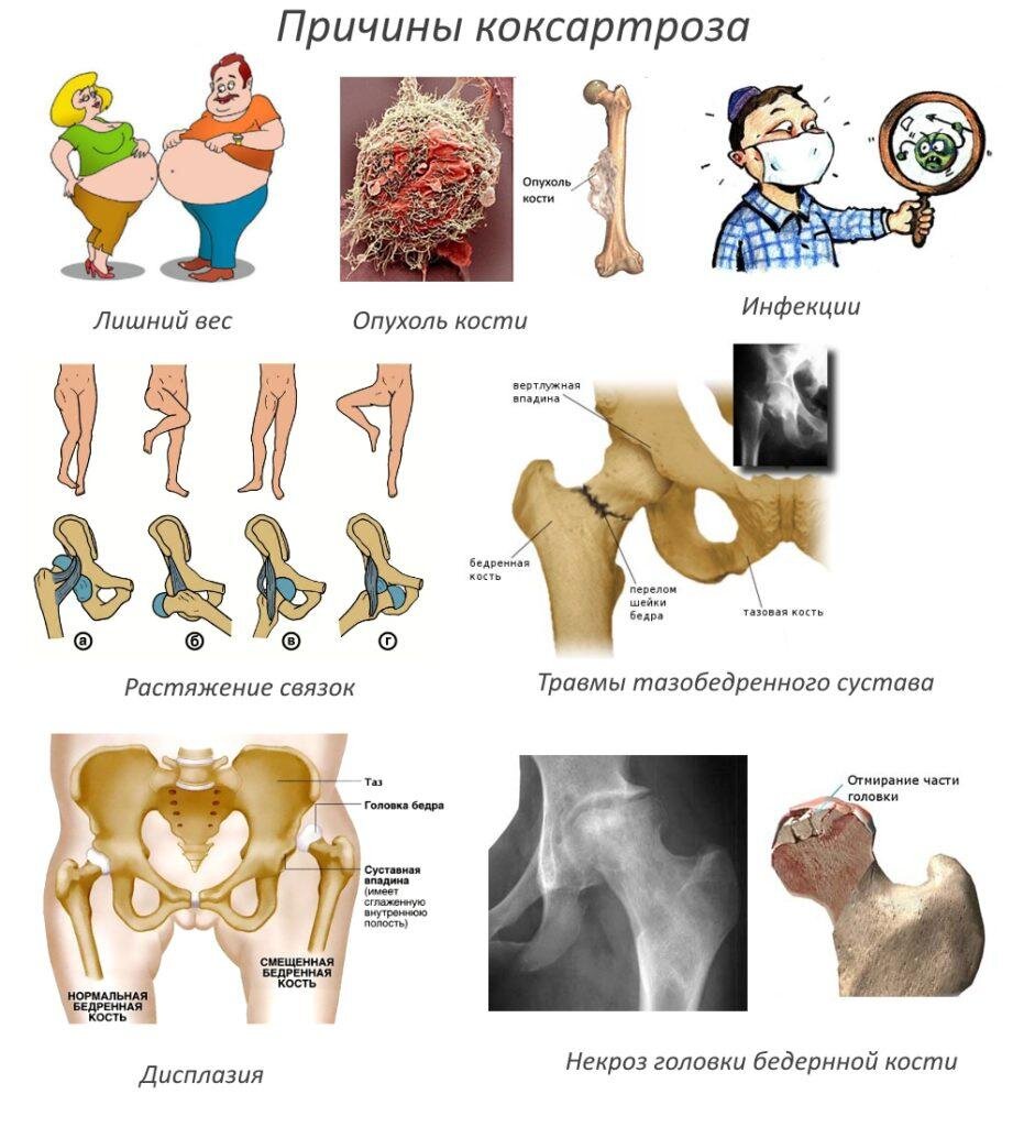 Схема лечения коксартроза тазобедренного сустава 2 степени