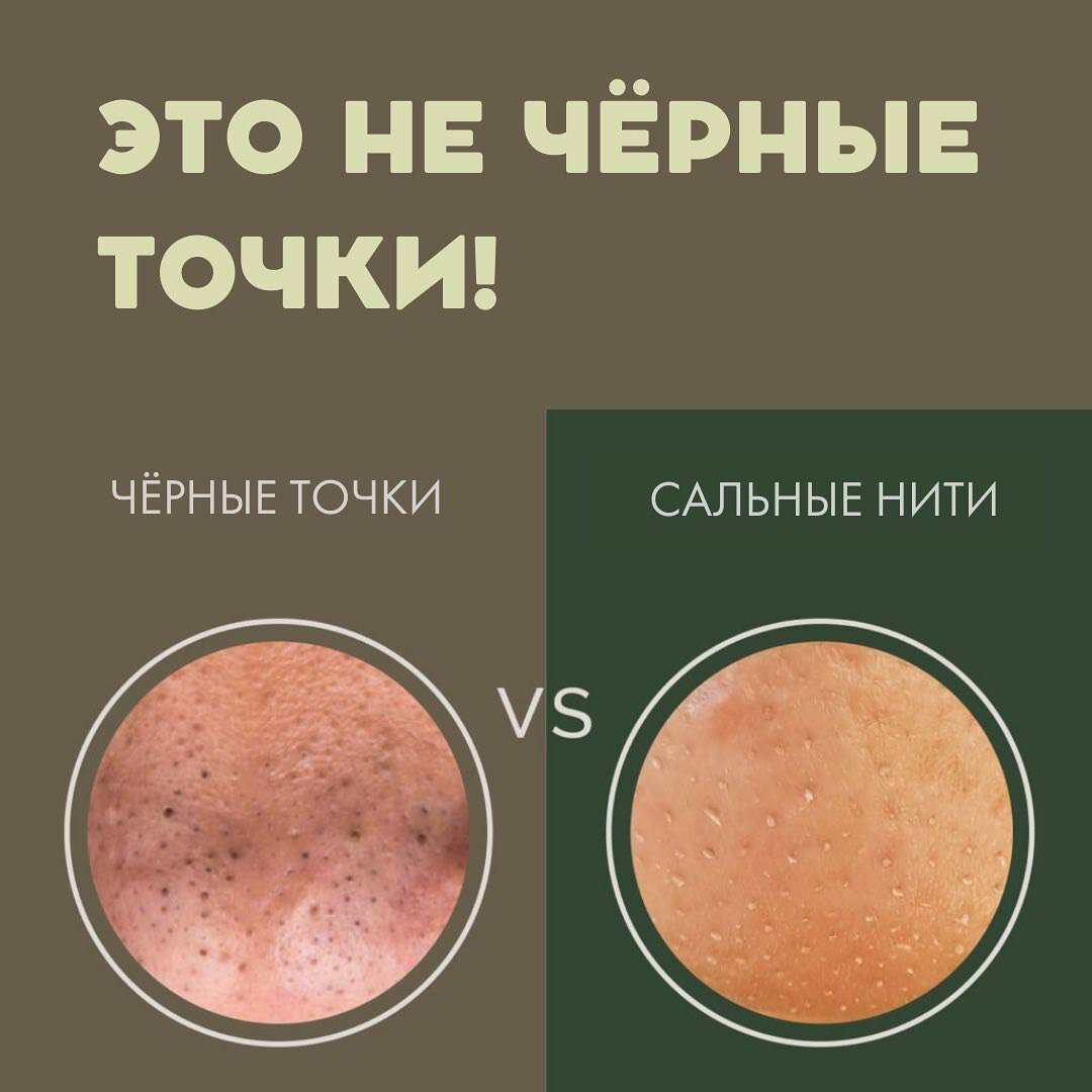 Сальные нити на лице как выглядят