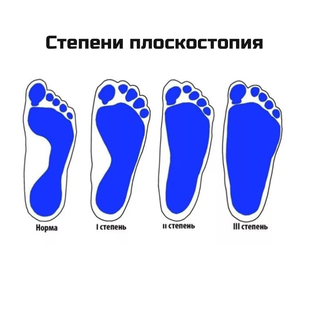 3 Я степень плоскостопия