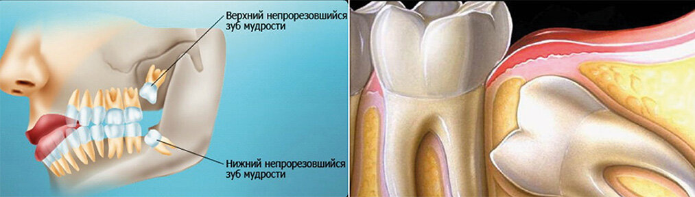 Зубы мудрости