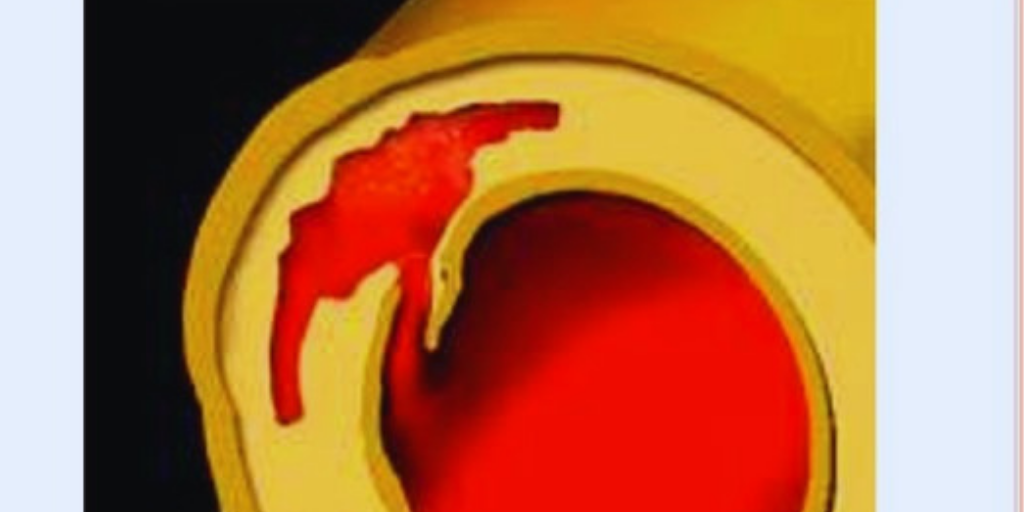 Кровь застревает в поврежденной стенке аорты.