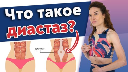 Как самостоятельно определить диастаз живота? Что будет, если не лечить диастаз?