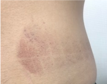  рис. 1; Пациент, 22 г. Петехиальная сыпь на 2 сутки после процедуры криолиполиза.
