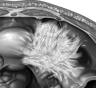 На фото спайки малого таза. Фото: expdoc.ru