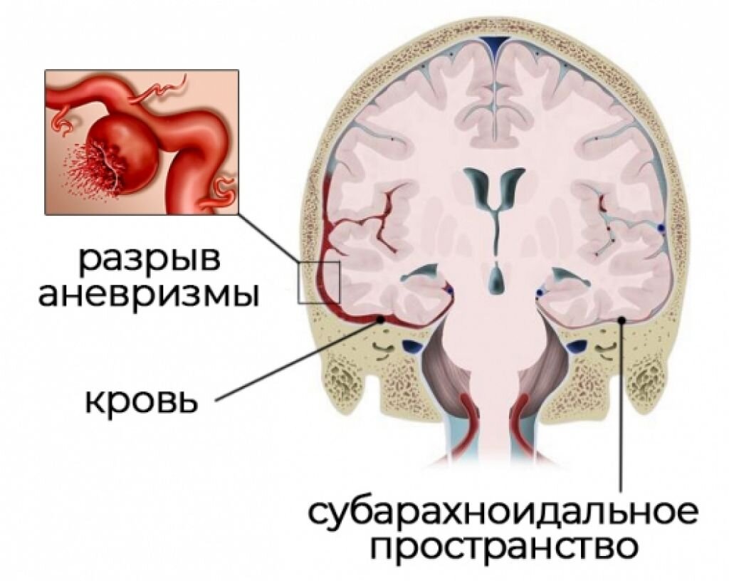 Разрыв мозга картинки