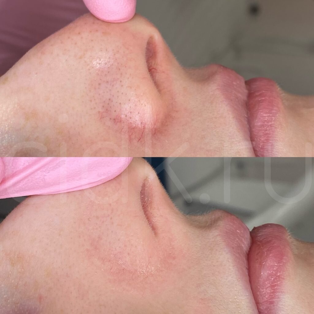 ДО/ПОСЛЕ удаления купероза