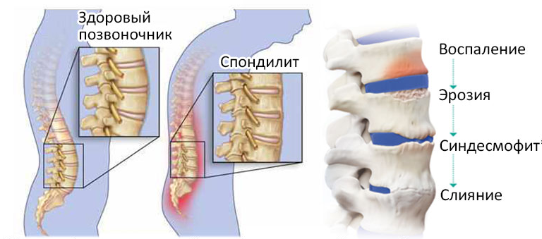 Спондилит это