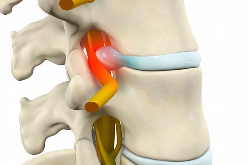 Лечение грыж позвоночника без операции