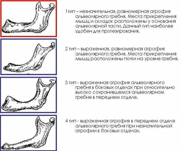 Альвеолярный отросток: что это, дефекты, атрофия, переломы, воспаления и лечение