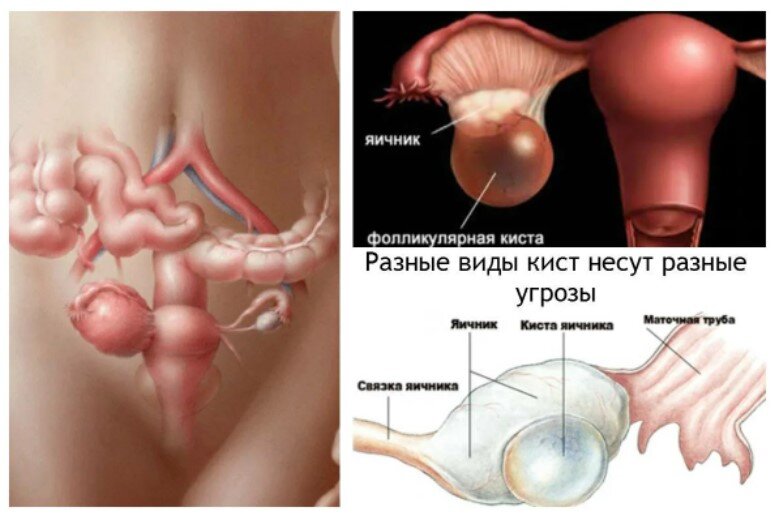 Какие бывают кисты у яичников