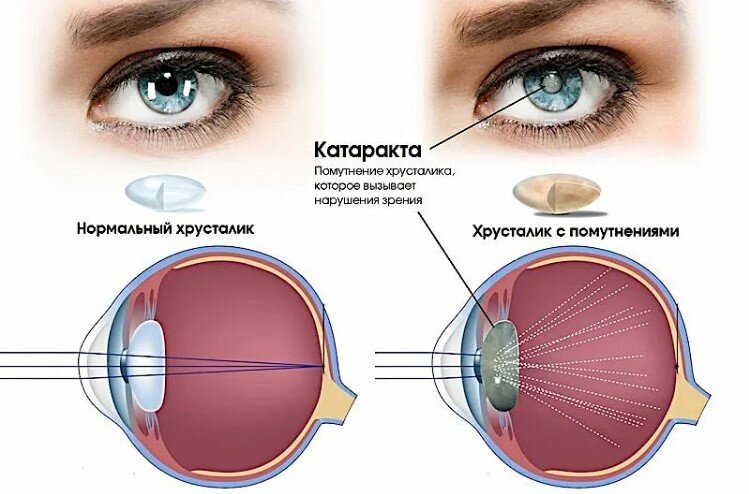 Что такое катаракта?