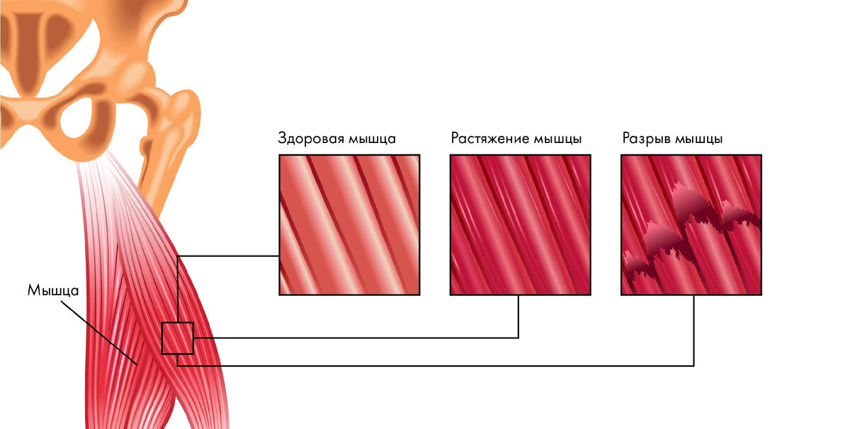 Повреждение мышечных волокон. Разрыв мышечных волокон.