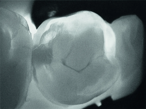 Диагностика кариеса. Аппарат DIAGNOCAM. Диагнокам в стоматологии. KAVO DIAGNOCAM. Трансиллюминационный метод DIAGNOCAM.