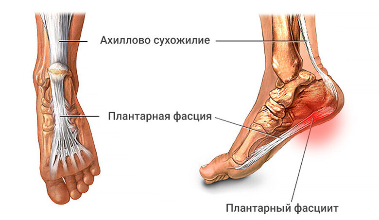 Откуда берется пяточная шпора и как ее лечить? | Доктор ОСТ | Центр ...