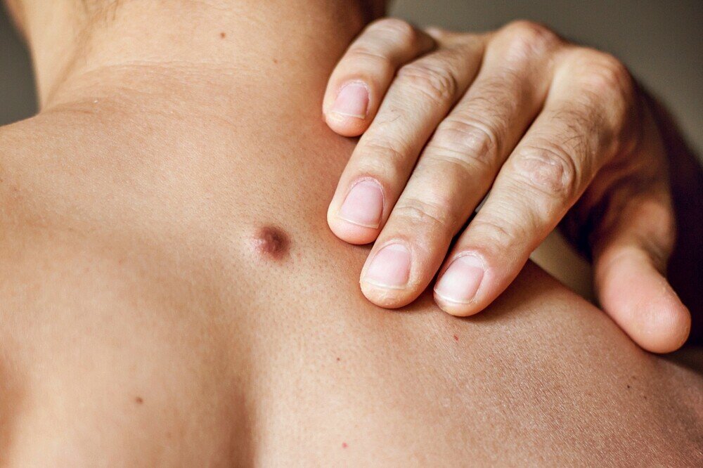 Если воспалилась родинка