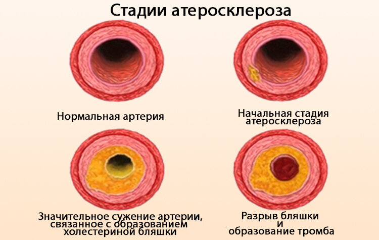Стадии атеросклероза картинки