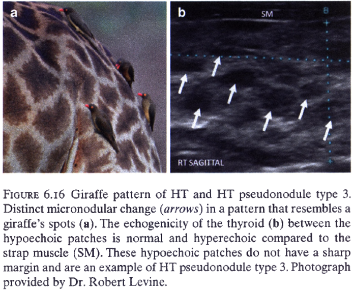 И американского руководства по УЗИ щитовидной железы Duick DS, Lupo MA, Levine RA Thyroid and Parathyroid Ultrasound and Ultrasound-Guided FNA. Link. 2018. 546 p. 