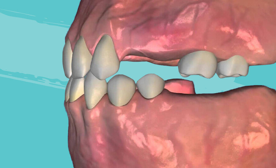 Виды протезирования при полном отсутствии зубов