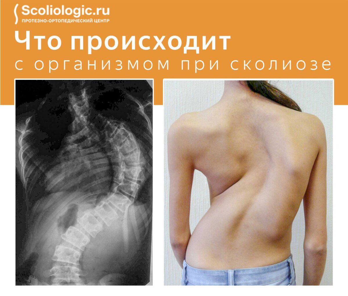 может ли болеть грудь из за сколиоза фото 50